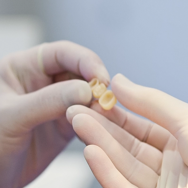 Aufnahme von Veneers: Dünne Keramikschalen zur Korrektur von Form, Farbe oder kleinen Zahnfehlstellungen