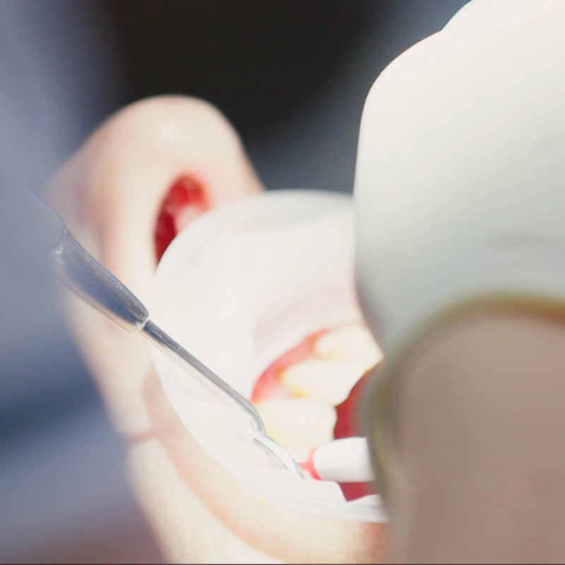 Nahaufnahme des rechten Mundbereichs eines Patienten während einer Zahnbehandlung