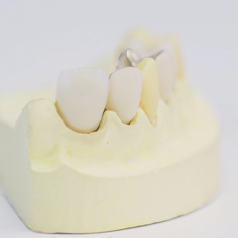 Detailaufnahme eines Zahnmodells aus Gips mit Zahnersatz